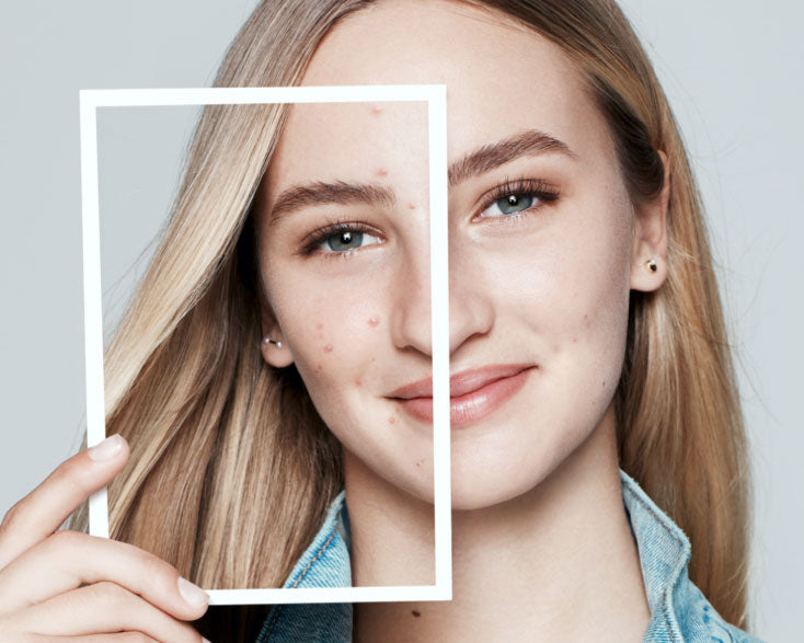 The Dos and Don’ts of Making Pimples Go Away