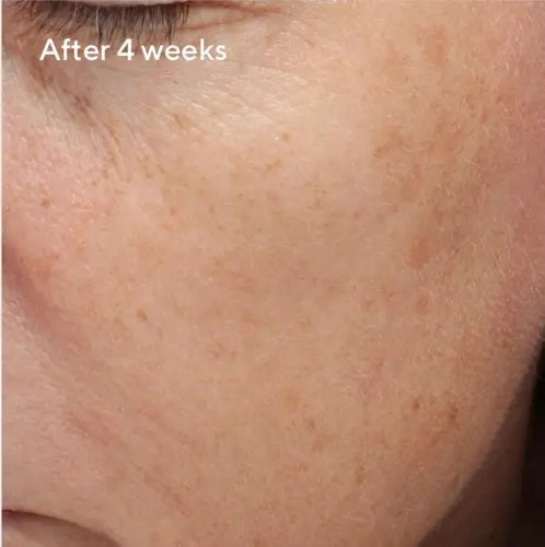 a close up of a person's face 4 weeks after application