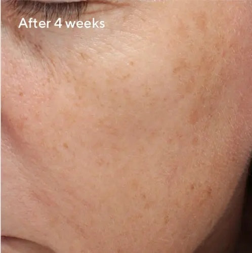 a close up of a person's face 4 weeks after application