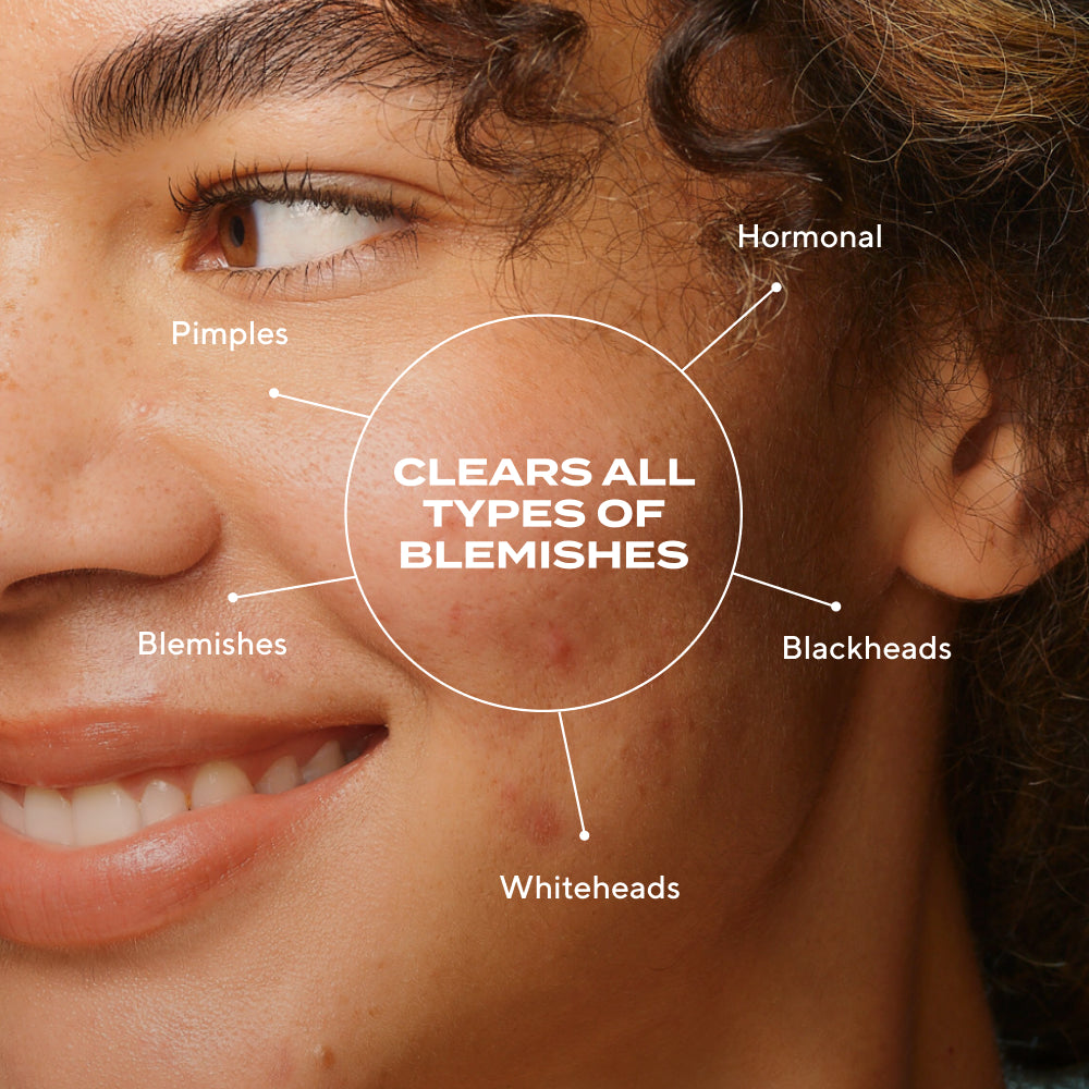Biome-Balancing Clear & Prevent Blemish Treatment Serum