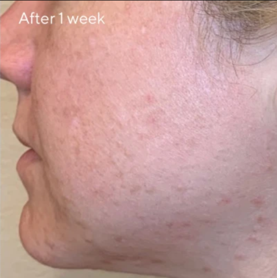 AHA/BHA Retinoid Daily Clarifiying Peel results after