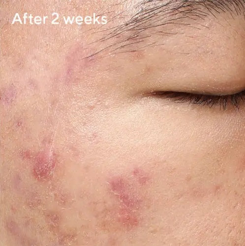 After 2 weeks of application