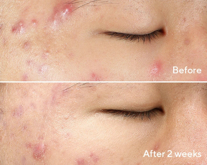 Untouched real results before and 2 weeks after use