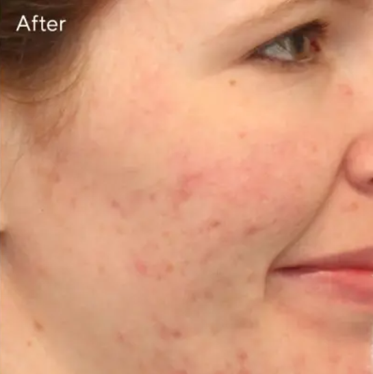 Blemish Clearing Set results after