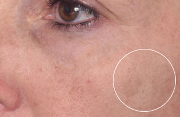 Rapid Dark Spot Correcting Serum results after