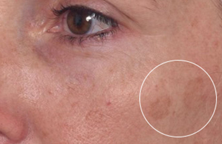 Rapid Dark Spot Correcting Serum results before