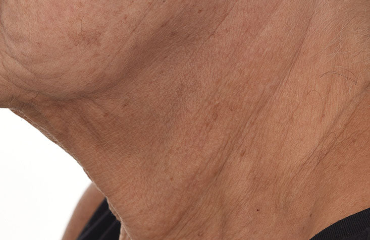 Retinol ReSculpt Overnight Treatment results after