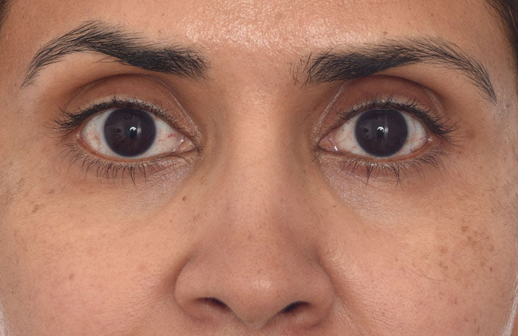 Retinol Youth Renewal Eye Mask results after