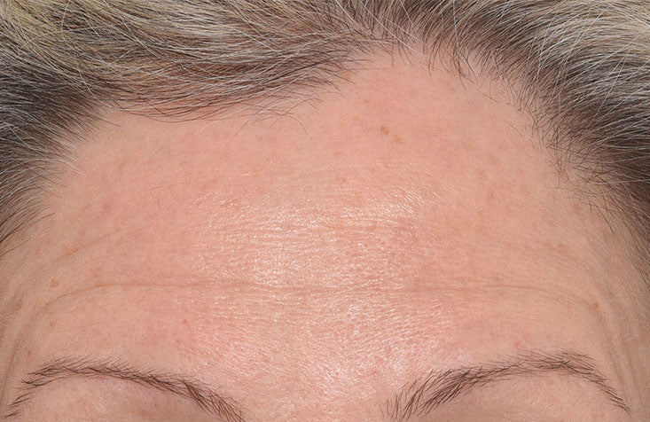 Targeted Wrinkle Corrector results before