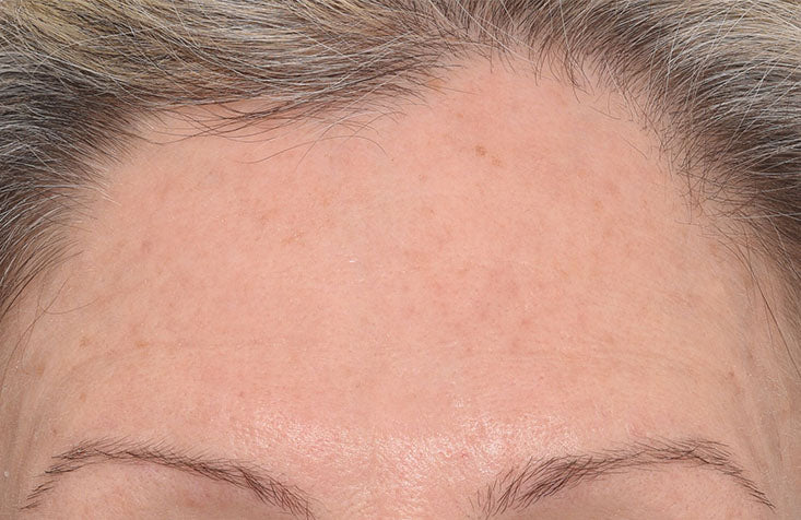 Targeted Wrinkle Corrector results immediately after
