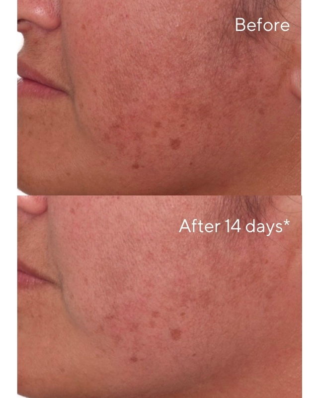 Rapid Dark Spot Correcting Serum Before and After