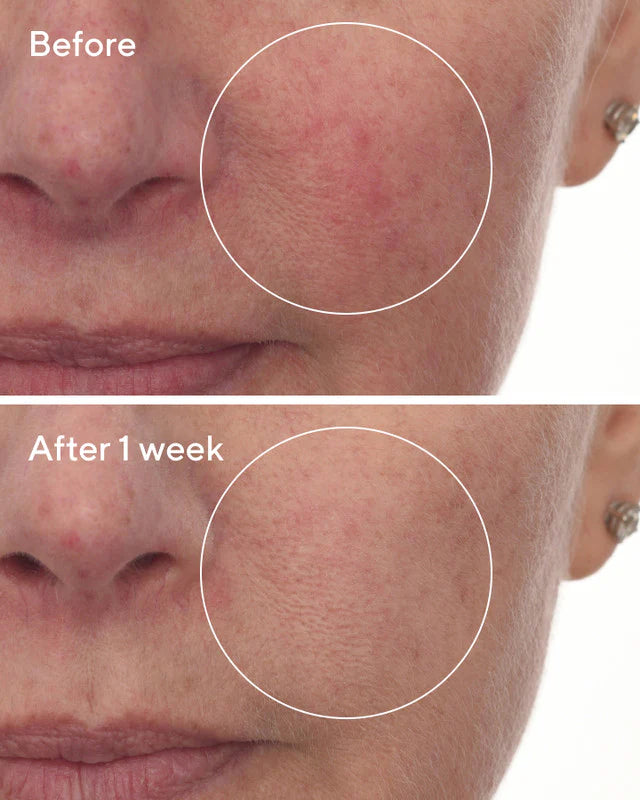 Skin Barrier Protection