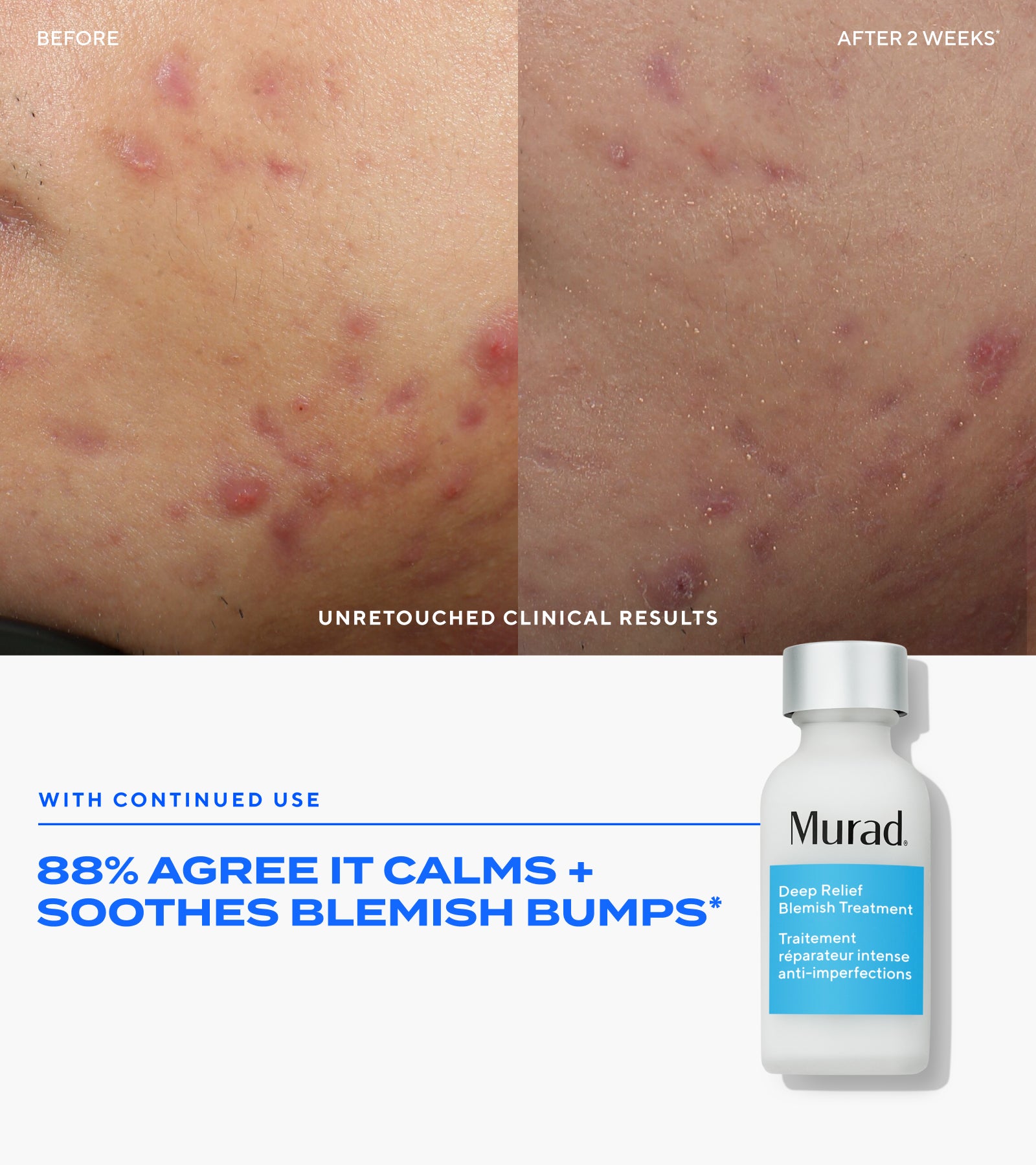Complete Blemish Regimen