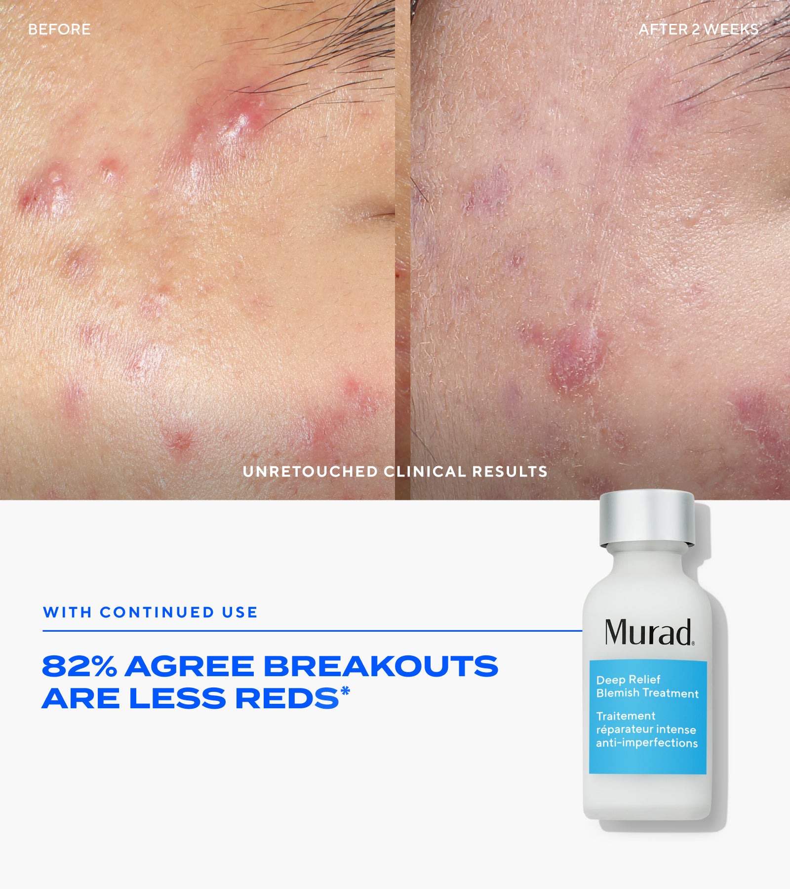 Complete Blemish Regimen