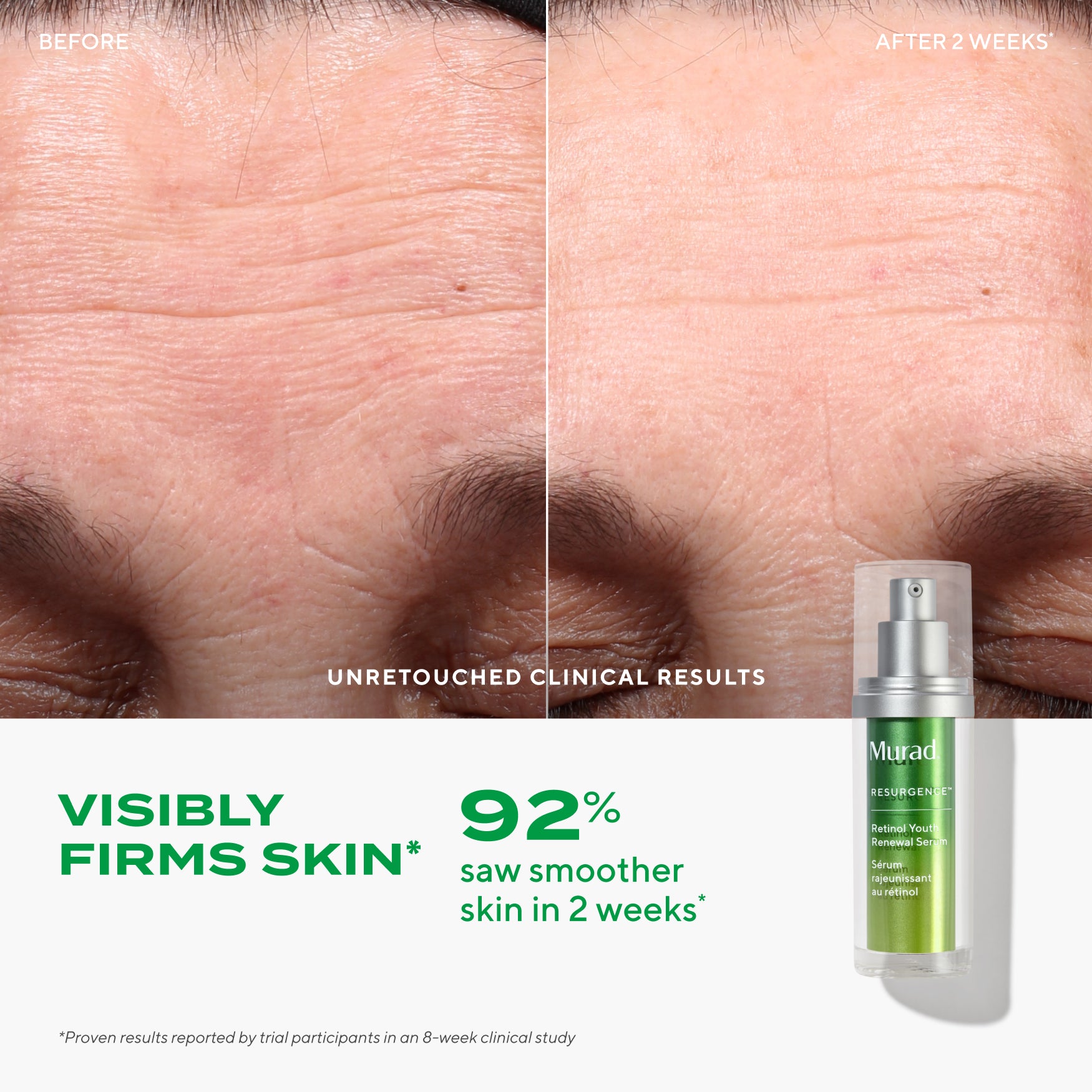 Lines & Wrinkles