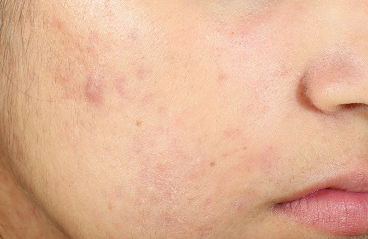 InvisiScar Resurfacing Treatment results after