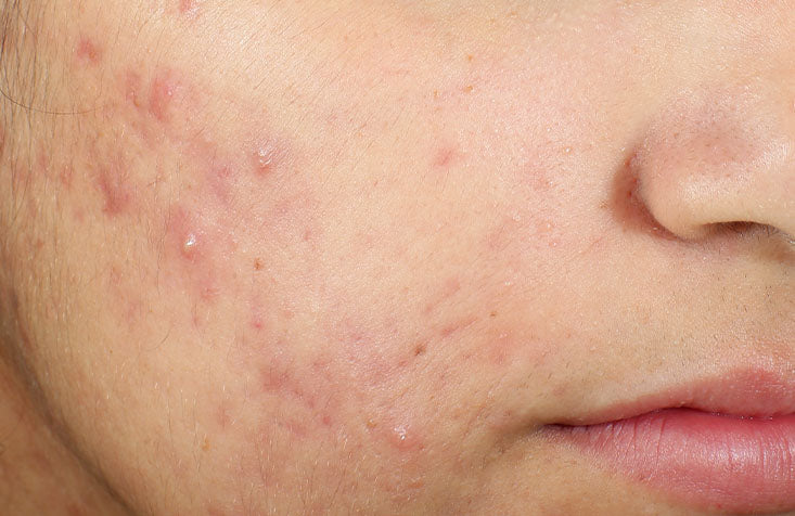 InvisiScar Resurfacing Treatment results before