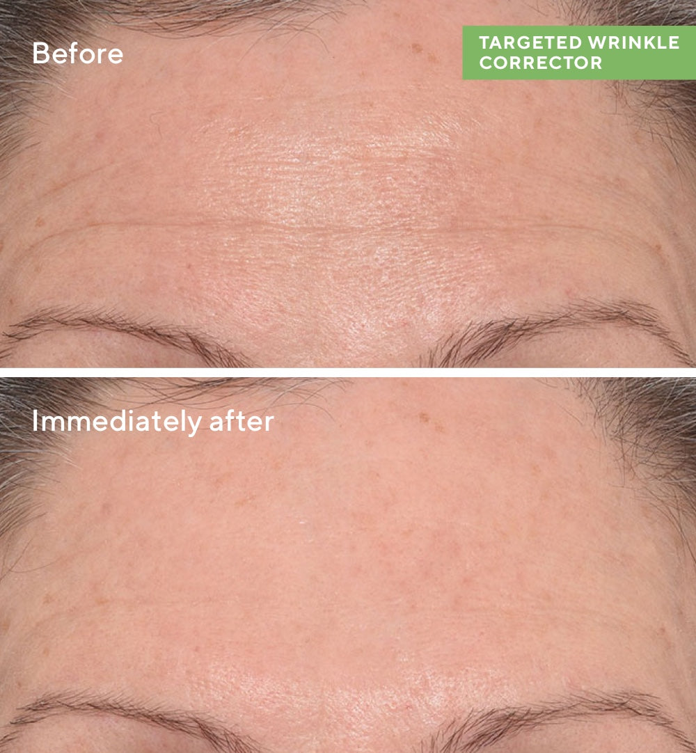 Rapid Wrinkle Repair