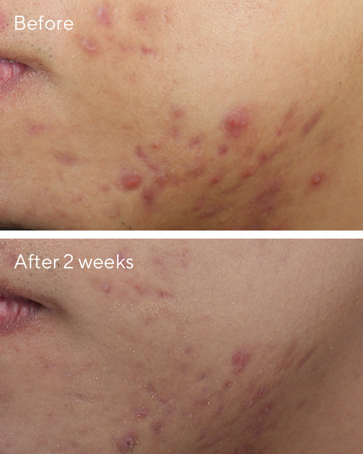Murad Deep Relief Blemish Treatment, before and after, results