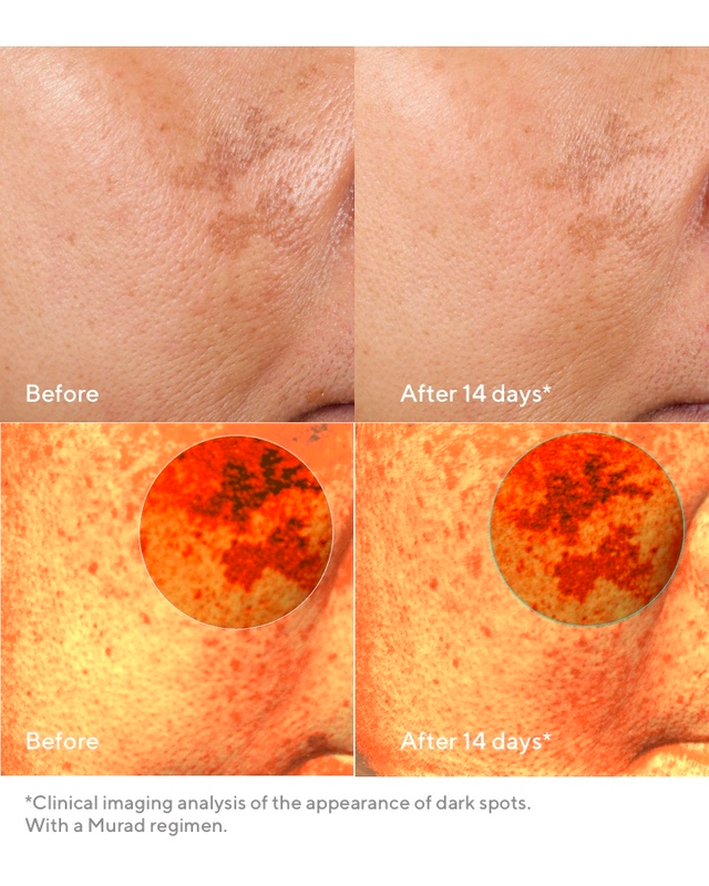 Rapid Dark Spot Correcting Serum Before and After
